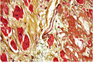 Fig.1 Micrograph of a heart with fibrosis and amyloidosis. (Wikipedia)