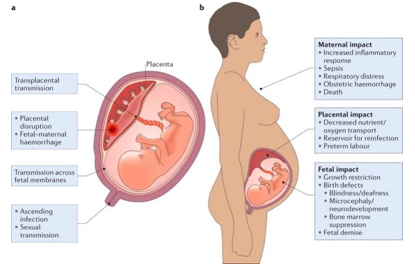 Fig.1 Routes of transmission across the placenta and consequences of infection. (Megli, 2022)